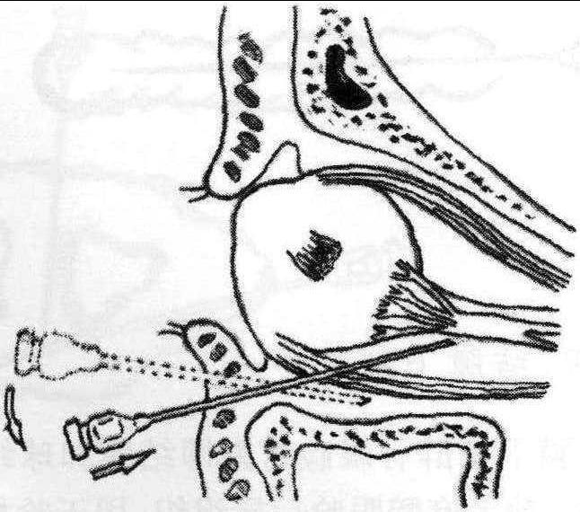 一、睫狀神經(jīng)節(jié)阻滯麻醉
